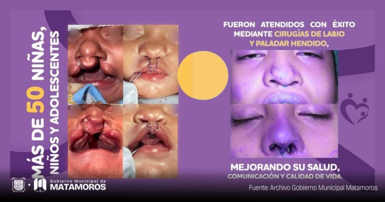 Más de 50 niñas, niños y adolescentes beneficiados en campaña “Sonriendo Juntos” en Matamoros